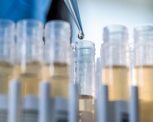 Bei einem klassischen Diagnose-Verfahren zur Erkennung von Hautpilz, Haarpilz oder Nagelpilz wird im hautärztlichen mykologischem Labor mit einer Pipette ein Reagenzglas mit einer Hautprobe befüllt. Viele Behälter enthalten Proben, die ausgewertet werden.