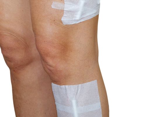 Legs of a patient after surgical removal of varicose veins. The skin of the legs is taped with sterile medical plasters. After the miniphlebectomy, small wounds appear on the skin that heal without scars in a few weeks.