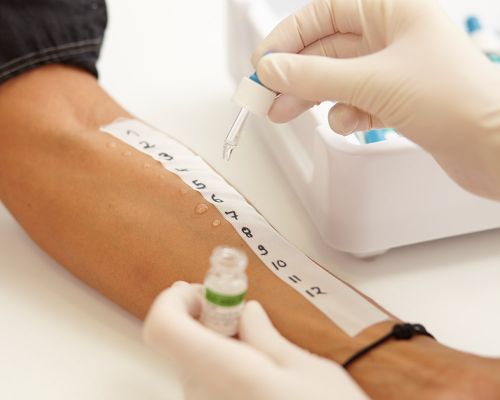 A patient's arm being tested for allergens on her skin. An adhesive strip with numbers is stuck on the arm. A doctor drips a liquid onto the skin next to the numbers. Skin reactions are used to analyze the trigger of an allergy.