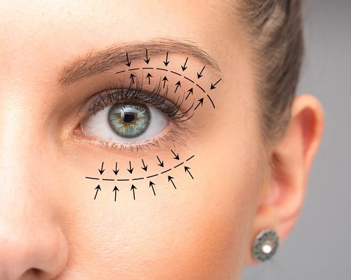 Detail of a woman's face with eyelid wrinkles. The image is focused on one eye. Arrows are drawn on the eyelids, which indicate the possibilities of skin treatments with plasma pen for upper or lower eyelid tightening.