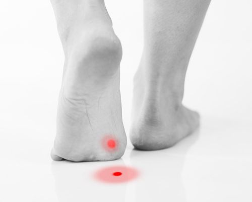 Bare male feet stepping on a shiny floor. The skin is visible. One foot is on the ground and the other is on tiptoe. A wart is visible on the sole of the foot. The foot wart is highlighted with red color.
