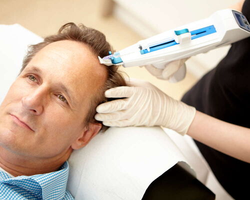 Mann in reiferen Jahren bei einer Mesotherapie gegen Haarausfall. Eine Medizinische Fachangestellte der hautärztlichen Praxis in der Fressgass‘ wendet das regenerative medizinische Verfahren gegen Haarausfall an, um Haarwachstum bei der Person anzuregen.