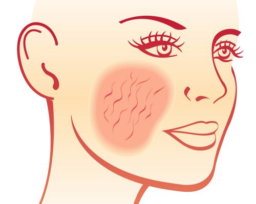 drawing of a face. Graphic representation of affected skin areas in skin diseases such as couperose and rosacea. These are treated with lymphatic drainage, oxygen treatment, fruit acid peelings, laser treatment, microneedling, and mesotherapy.