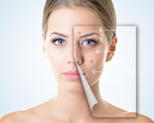 Gesicht einer jungen Frau mit gesunder Haut. Auf das abgebildete Gesicht ist eine Ebene mit einem Ausschnitt gelegt. Dieser unschöne Gesichtspart enthält Akne auf der Haut. Individuelle und vielfältige Behandlung von Akne könnte entgegenwirken.