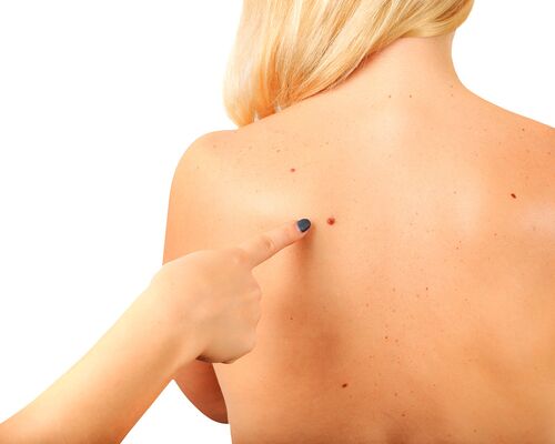 Eine medizinische Fachangestellte der Praxis Dr. Dötterer-Rieg und Kollegen zeigt auf eine auffällige Hautveränderung auf dem Rücken einer Patientin, die auch Schwarzer Hautkrebs sein könnte. Eine Diagnose der Hautstelle wird es feststellen.