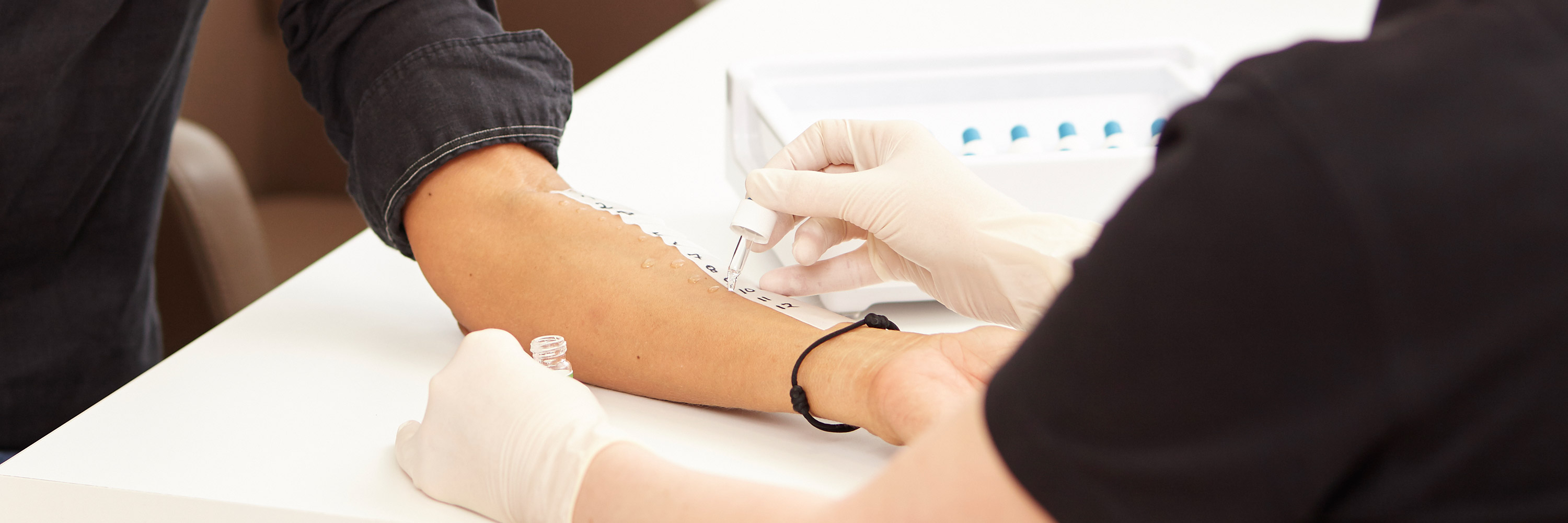 A patient undergoing an allergy test. A dermatologist's hand, wearing gloves, drips an allergen liquid onto the patient's skin. Skin reactions are used to diagnose allergies and decide on subsequent treatment methods.